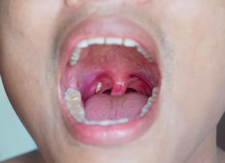 Does Vaping Cause Tonsil Stones? Find Out Now! Does Vaping Cause Tonsil Stones