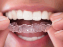 The Importance of Mouthguards