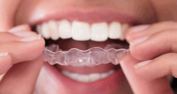 The Importance of Mouthguards