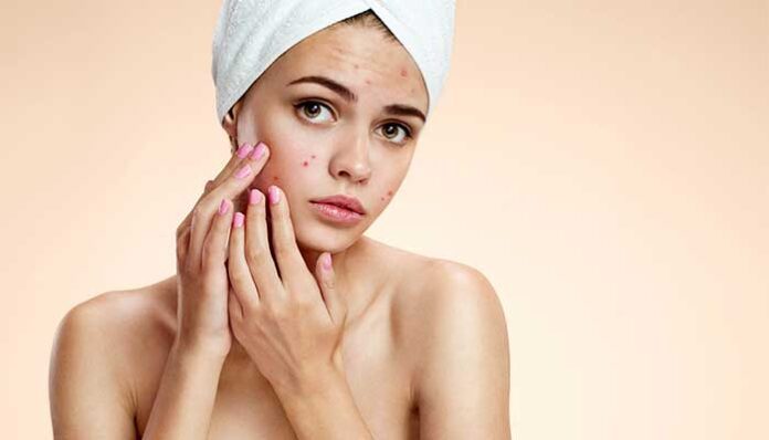How to Combat Acne Wherever It Appears