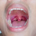 Does Vaping Cause Tonsil Stones? Find Out Now! Does Vaping Cause Tonsil Stones